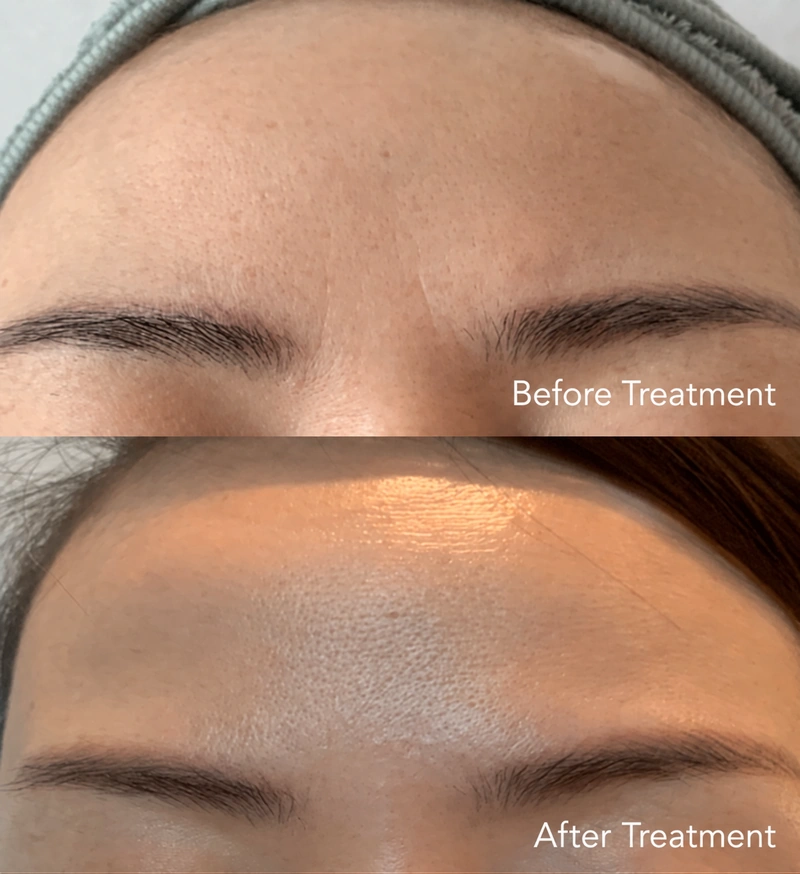 High Pure Exosomes case: brow-area photographs labelled before on top and after below